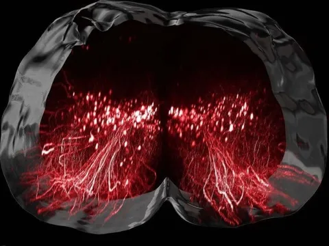 Truyền điện bằng phương pháp đột phá, 9 người bị liệt đi lại được