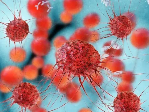 Gặp điều tưởng không liên quan này, tử vong do ung thư tăng 2,4 lần