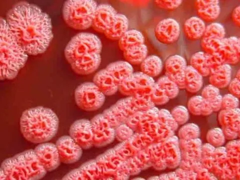 Những biểu hiện lâm sàng thường gặp của bệnh Whitmore