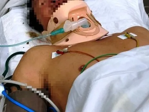 Bị tôn trên xe ba gác cắt trúng cổ, người đàn ông suýt chết