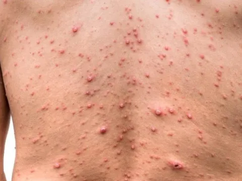 Số ca thủy đậu ở Hà Nội tăng cao, chuyên gia chỉ cách phòng tránh