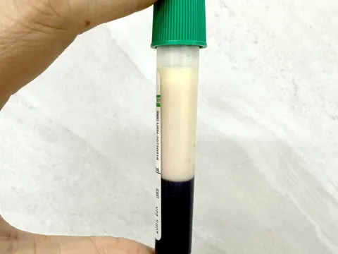 Uống thuốc giảm cân, trong máu người phụ nữ có lớp mỡ trắng đục như sữa