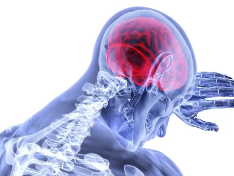 5 triệu người chết vì đột quỵ năm 2030: Cảnh báo 7 nguyên nhân hàng đầu
