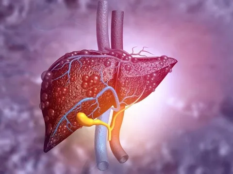 Không rượu vẫn gan nhiễm mỡ: Một rủi ro chết người tăng 71%