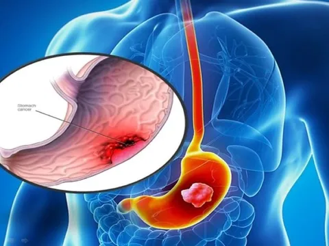 Chàng trai 25 tuổi bị ung thư dạ dày giai đoạn cuối vì thói quen khó bỏ