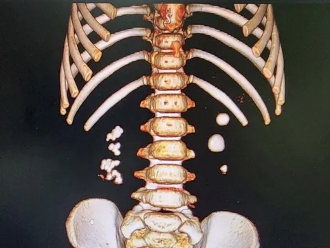 Bé trai 3 tuổi đi khám vì đau thắt lưng, đau mạn sườn, bác sĩ phát hiện bị sỏi thận 2 bên