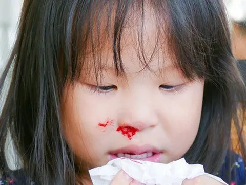 Bé trai 3 tuổi nguy kịch do bà nội xử lý chảy máu cam sai cách