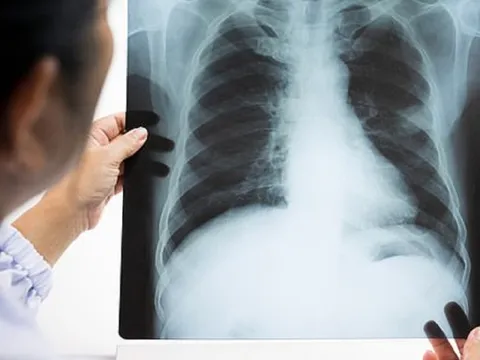 6 nhóm người dễ mắc ung thư phổi hơn bất cứ ai