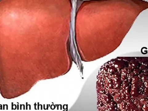 Ung thư gan có số ca tử vong dẫn đầu