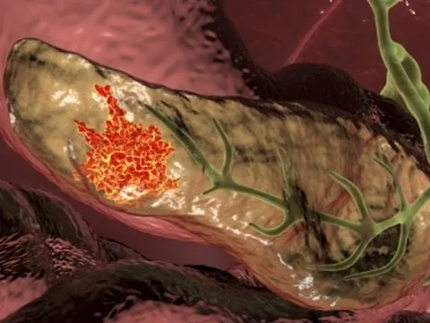 1 dấu hiệu sớm cảnh báo ung thư tuyến tụy: 75% bệnh nhân có triệu chứng này