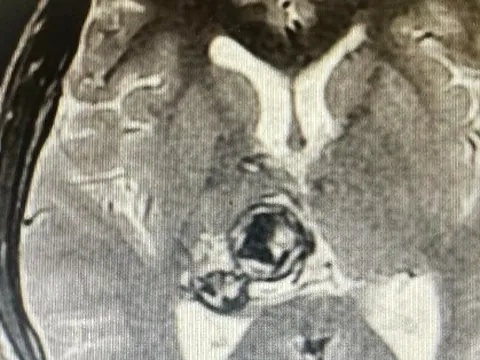 Nam sinh viên 20 tuổi phát hiện khối u não sau khi thấy đau đầu, chóng mặt