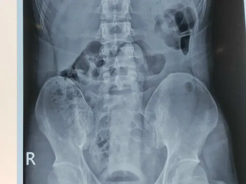 Nam thanh niên mắc kẹt đồ chơi tình dục trong... trực tràng