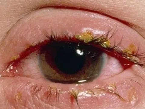 Tp.HCM: Ngành y tế đã xác định tác nhân gây ra bệnh đau mắt đỏ