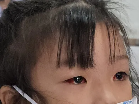 Đau mắt đỏ có lây qua đường uống?