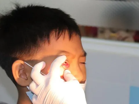 Đau mắt đỏ xu hướng gia tăng, Bộ Y tế ra 5 biện pháp phòng chống