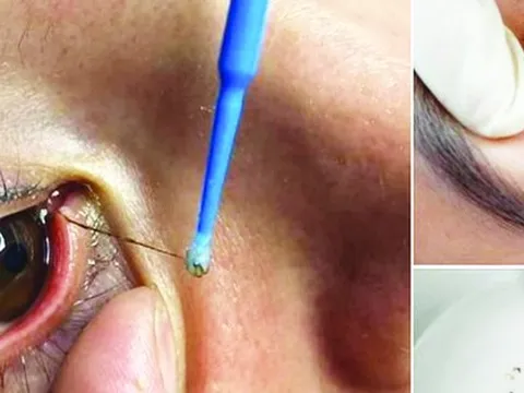 Bác sĩ nói gì về dịch vụ “bắt sâu mắt" đang nở rộ?