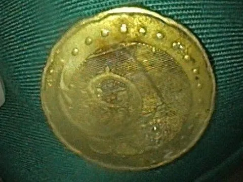 Ớn lạnh đồng xu mắc kẹt trong thực quản của bé gái 5 tuổi