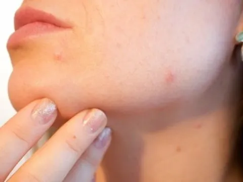 Bị viêm màng não vì việc tưởng vô hại nhiều người làm với khuôn mặt