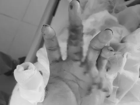 Giữ được bàn tay đứt lìa 2 ngón, nam thanh niên xúc động cảm ơn bác sĩ