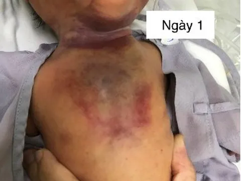 Bệnh hiếm khiến bé gái 1 ngày tuổi hẹp đường thở, suy hô hấp