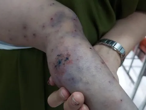 Bệnh nhi 3 tuổi tử vong vì bệnh tay chân miệng sau 15 phút nhập viện