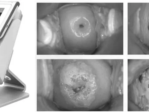 Bệnh viện sản khoa ở TP HCM dùng AI chẩn đoán sớm ung thư cổ tử cung