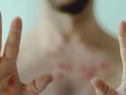 Cảnh báo sự nguy hiểm của bệnh đậu mùa khỉ