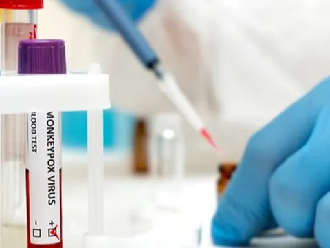 Dấu hiệu sớm nhận biết bệnh đậu mùa khỉ