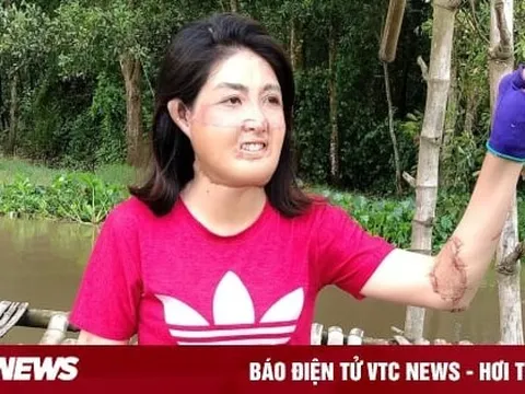 Sau 23 lần phẫu thuật, người phụ nữ từng bị chồng đổ xăng đốt hiện ra sao?