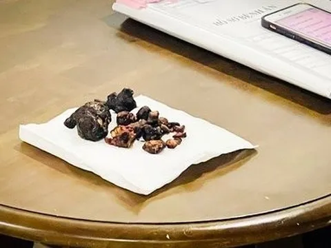 Đồng Nai: Phát hiện khối sỏi san hô lớn trong người bệnh nhân