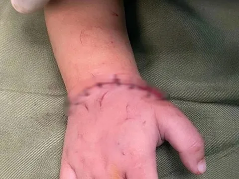 Bé gần 18 tháng tuổi bị máy cắt đá của gia đình cắt đứt lìa bàn tay