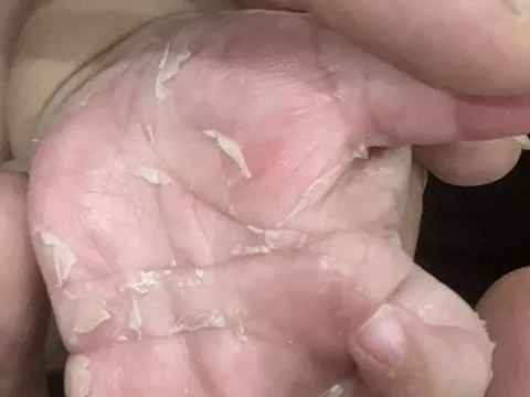 Nguyên nhân không ngờ khiến bé trai 3 tháng tuổi mắc bệnh giang mai