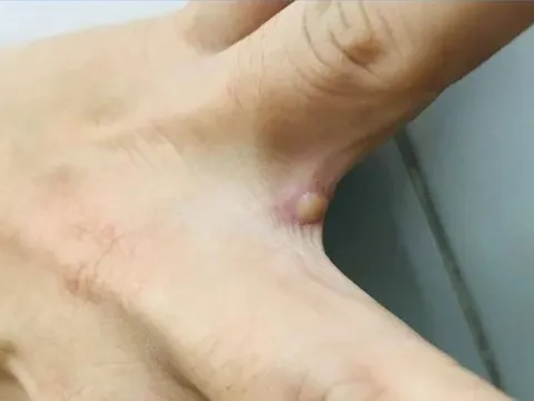 TP HCM ghi nhận ca bệnh đậu mùa khỉ ở quận Tân Bình