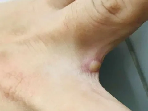 TP. Hồ Chí Minh đã có kết quả giải mã gene ca mắc đậu mùa khỉ nội địa đầu tiên