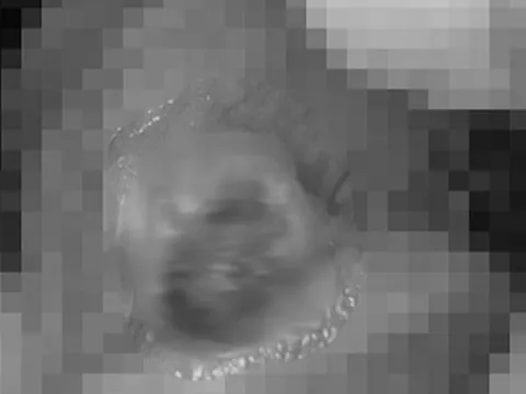 Sốt cao, tổn thương "của quý", người đàn ông mới biết bị giang mai