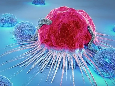 5 triệu chứng cảnh báo sớm ung thư: Có 1 dấu hiệu cũng cần đi khám