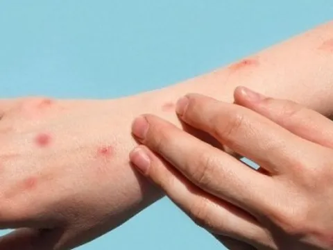 Long An ghi nhận ca đậu mùa khỉ đầu tiên