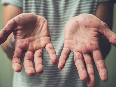 Chỉ trong 1 tuần TP HCM ghi nhận thêm 6 ca đậu mùa khỉ