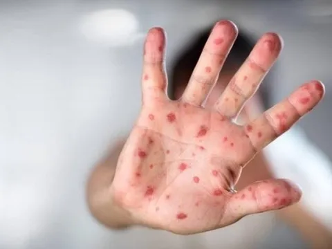 Bà Rịa - Vũng Tàu ghi nhận ca tử vong thứ 2 do bệnh tay chân miệng