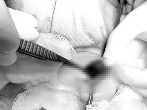 Bé trai 2 tuổi phải cắt bỏ tinh hoàn căn bệnh dễ gặp, cha mẹ thường bỏ qua dấu hiệu cảnh báo