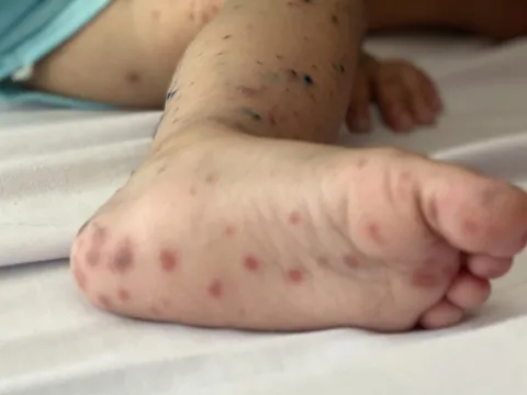 23 ca tử vong do tay chân miệng tại khu vực phía Nam