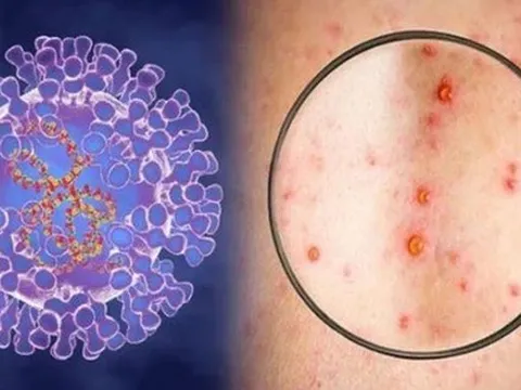 Đã có kết quả xét nghiệm bệnh nhân nghi mắc đậu mùa khỉ ở Đà Nẵng