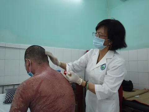 Mua thuốc vảy nến trên mạng biến chứng toàn thân