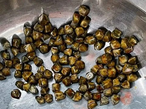 113 viên sỏi lấp đầy túi mật bệnh nhân