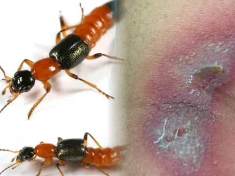 Kiến ba khoang vào mùa bùng phát, bác sĩ hướng dẫn cách xử trí