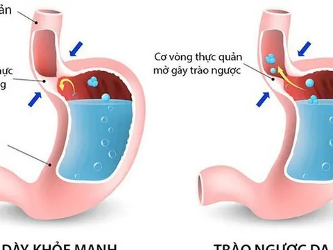 Bệnh trào ngược dạ dày - thực quản: 5 biến chứng nguy hiểm