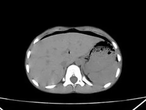 Bị bạn học trêu đùa, bé 8 tuổi thủng trực tràng do ngồi vào chiếc bút dựng ngược