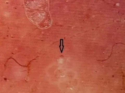 Bị ghẻ ở "của quý" nhưng phòng khám tư lại đốt để trị sùi mào gà