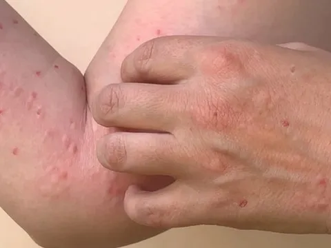 7 địa phương ghi nhận 56 ca nhiễm đậu mùa khỉ