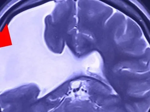 Người phụ nữ gần 30 năm sống chung với nứt não